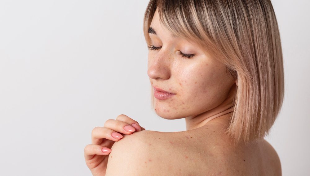 Akne Nedir? Akne Tedavisi Nasıl Yapılır?