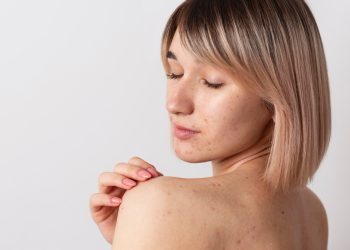 Akne Nedir? Akne Tedavisi Nasıl Yapılır?