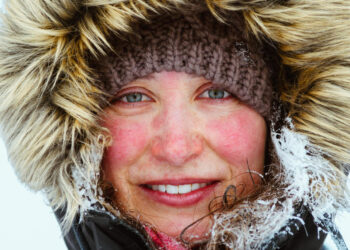 Soğuk Alerjisi Nedir?