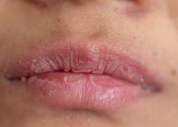 Dudak Çatlamasını Önlemenin Yolları