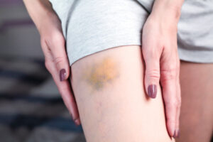 Bacaklardaki Sebepsiz Morarmaların Nedenleri Ne Olabilir?