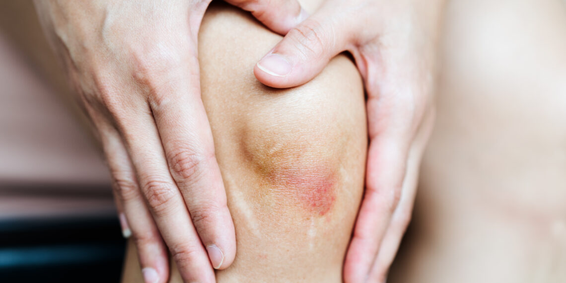 Bacaklardaki Sebepsiz Morarmaların Nedenleri Ne Olabilir?