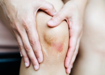 Bacaklardaki Sebepsiz Morarmaların Nedenleri Ne Olabilir?