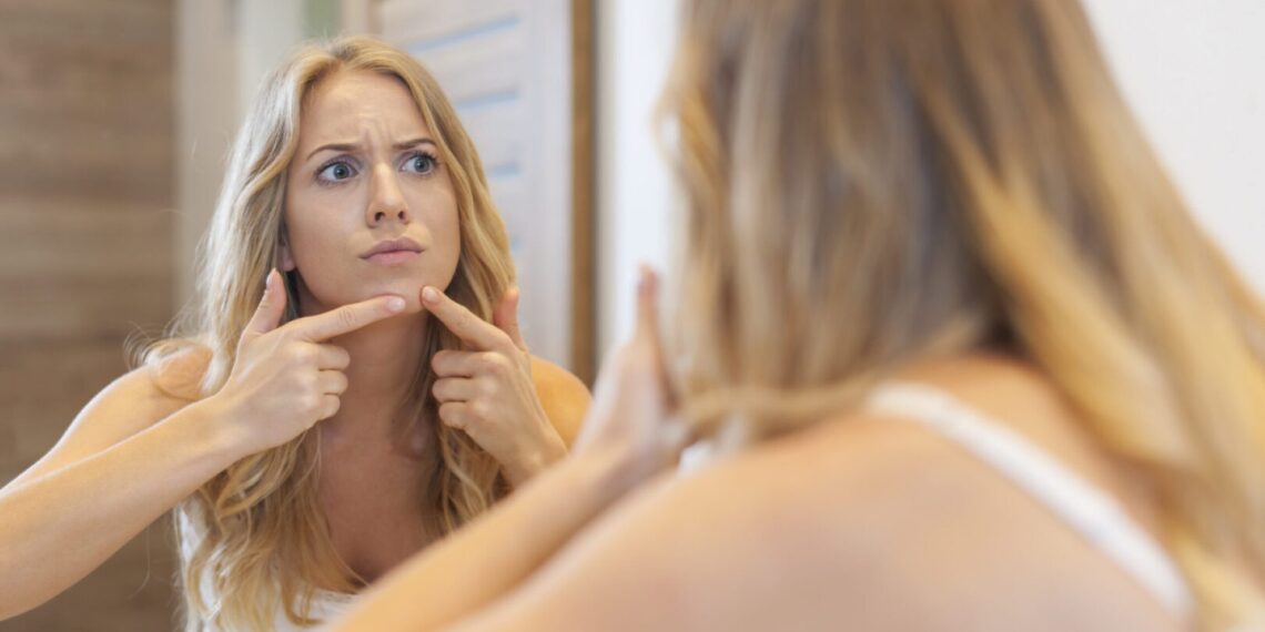 Çenede Sivilce Neden Çıkar? Hormonel Akne ve Çözüm Yolları