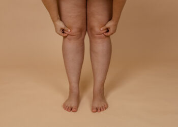 Vücutta Ödem Neden Olur? Hızlı Ödem Atmanın 7 Yolu