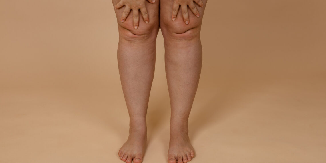 Bacaklarınız Neden Ağrılı ve Şiş? Lipödem (Ağrılı Yağlanma Sendromu) Hakkında Bilmeniz Gereken Her Şey