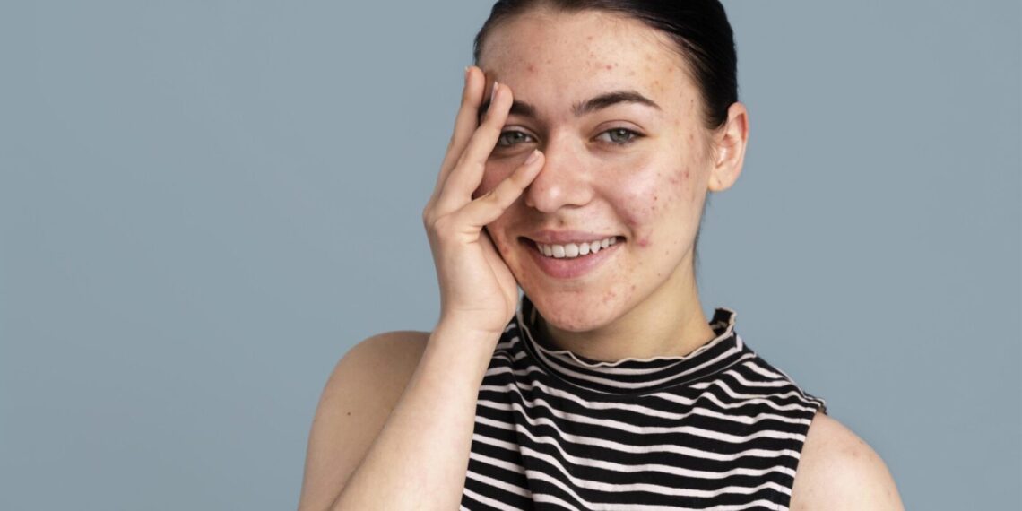 Komedonlara Karşı En Güçlü İkili: Salisilik Asit ve Retinol'ün Mucizevi Etkisi