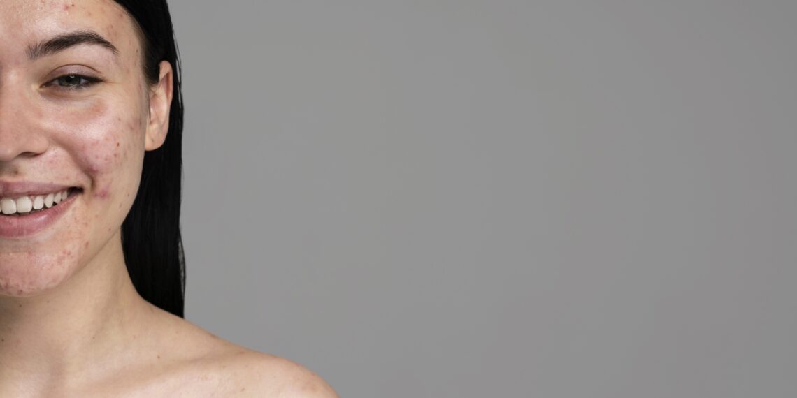 Hamilelikte Sivilce Neden Olur, Ne Zaman Başlar ve Nasıl Kontrol Edilir?