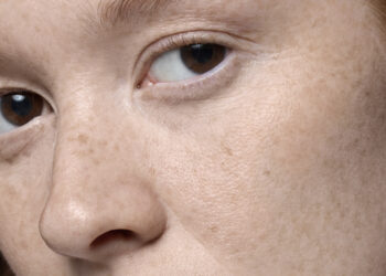 Cilt Lekeleriyle Savaşta En Etkili İçerikler