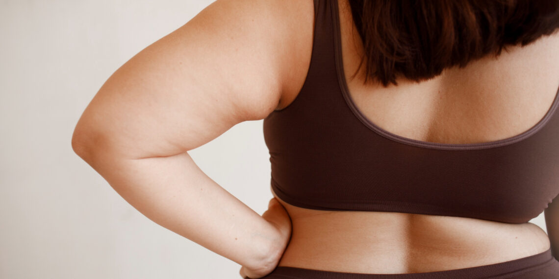 Lipödem ile Şişmanlık Arasındaki Fark Nedir?