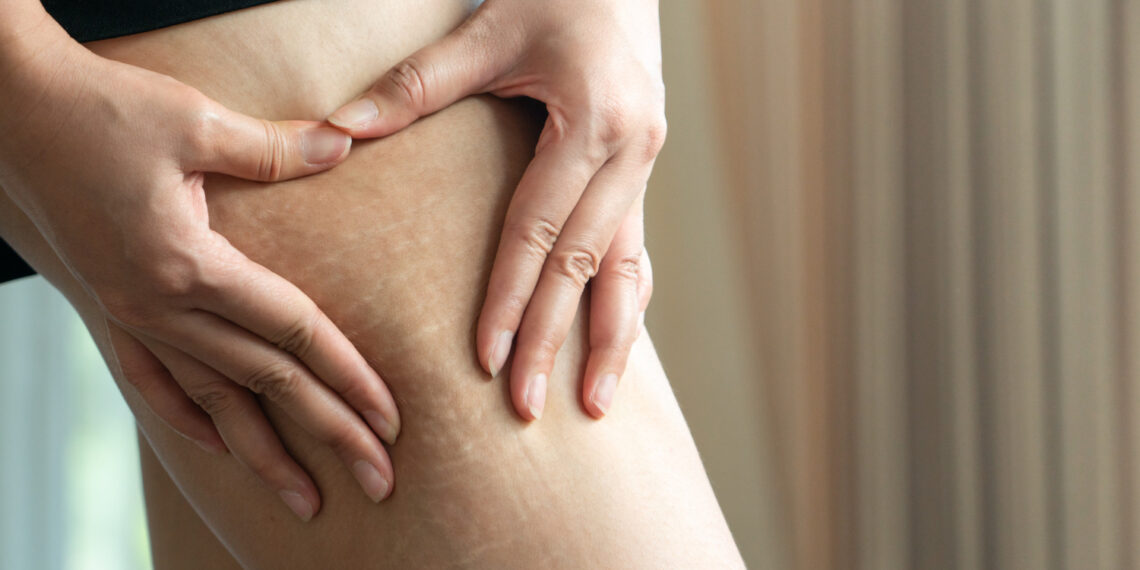 Yaza Kadar Selülitleri Yok Et