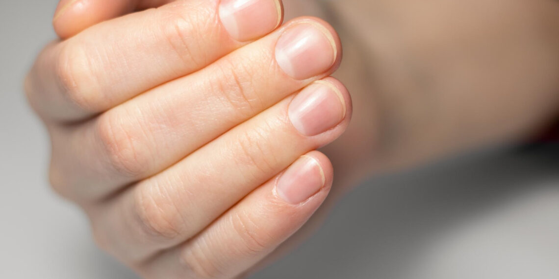 Tırnak Kırılmasına Hangi Vitamin İyi Gelir?