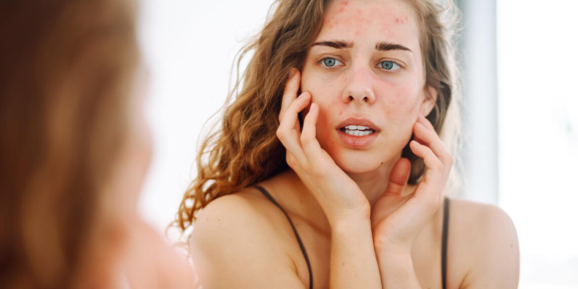 Sivilce Oluşumunu Tetikleyen Gıdalar ve Alternatifleri